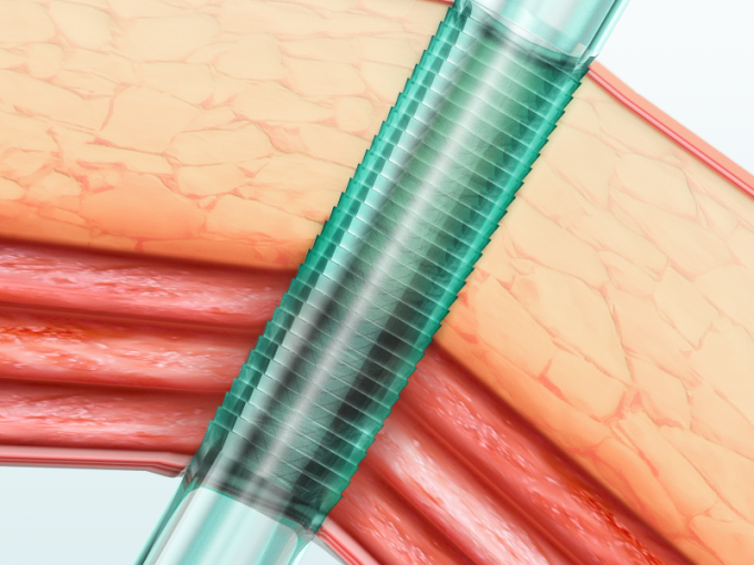 Trocart optique sans lame, jetable, pour laparoscopie, Classe II 0