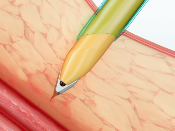 Instruments laparoscopiques Trocar cannule jetable avec lame 1
